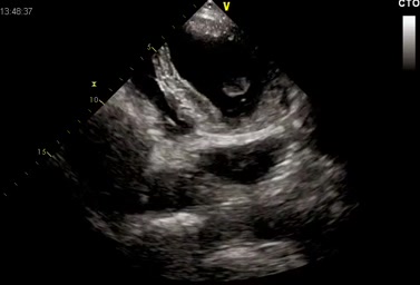 Persistenza della vena cava superiore sinistra