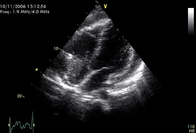 Vegetazioni su catetere