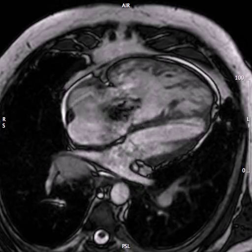 Ipertensione polmonare