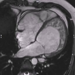 Non compattazione del VS