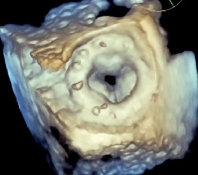 Protesi biologica mitralica Carpentier 25