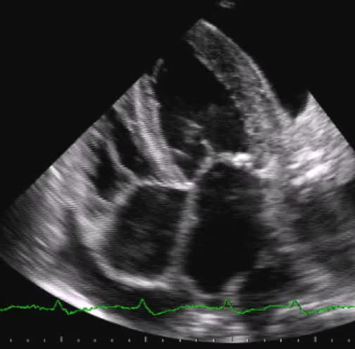 Versamento pleurico e pericardico