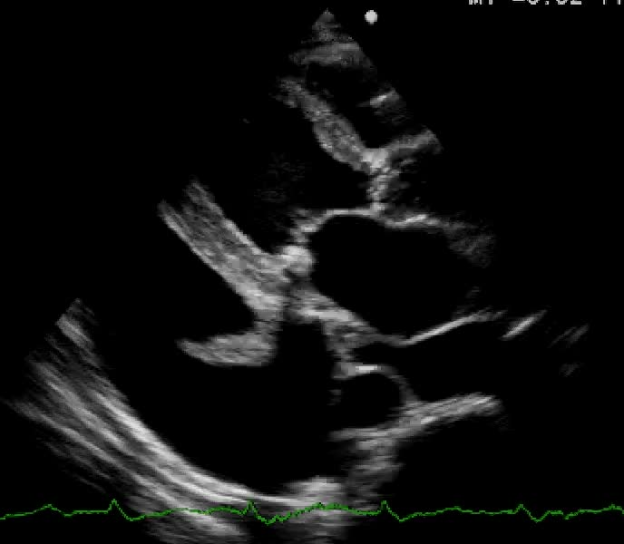 Versamento pleurico sinistro