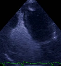 Trombosi di entrambi gli apici ventricolari