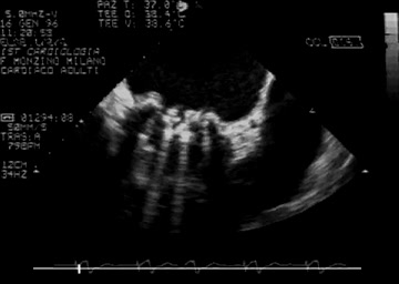 Endocardite su protesi mitralica