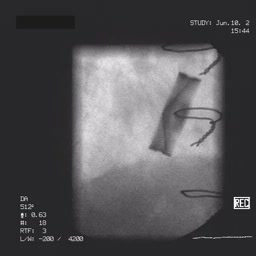 Ostruzione di protesi mitralica bidisco da panno e trombosi