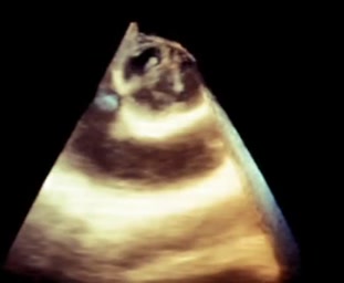 Bicuspida aortica senza stenosi valvolare