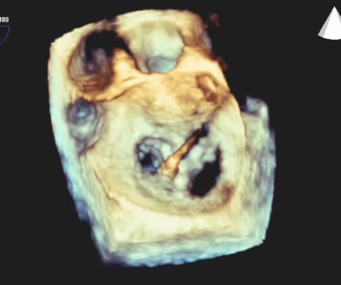 Impianto di Mitraclip: Monitoraggio ecocardiografico