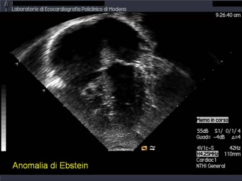 Ebstein