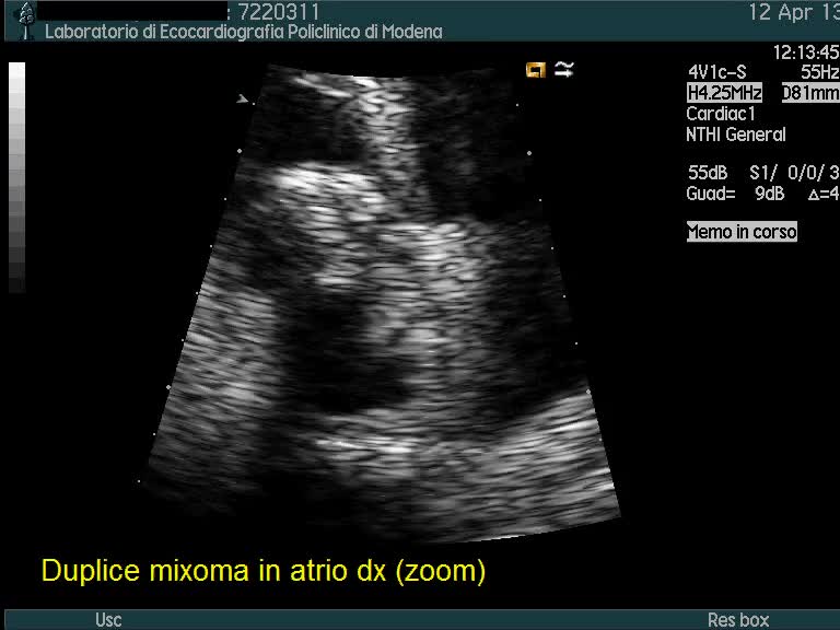 Duplice mixoma