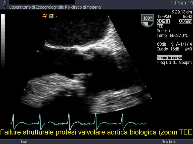 Insufficienza protesi aortica