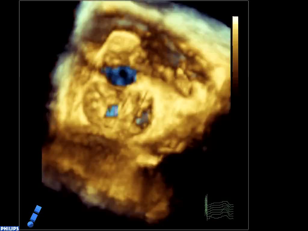 Valvola aortica e mitralica