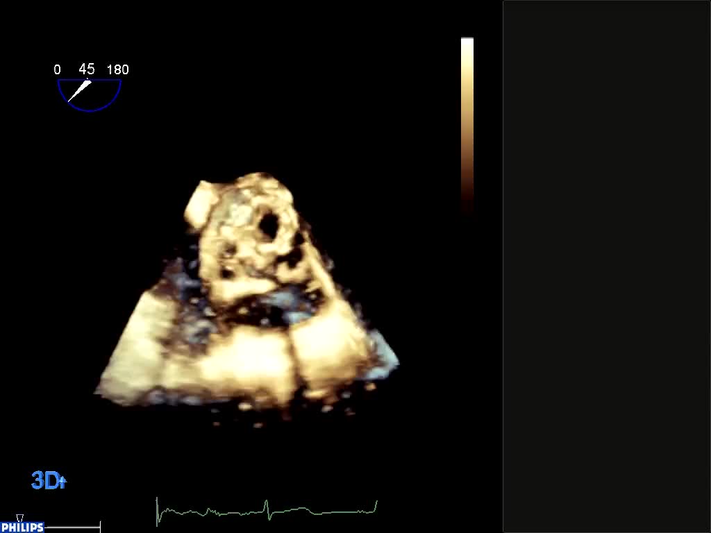Distacco di protesi aortica