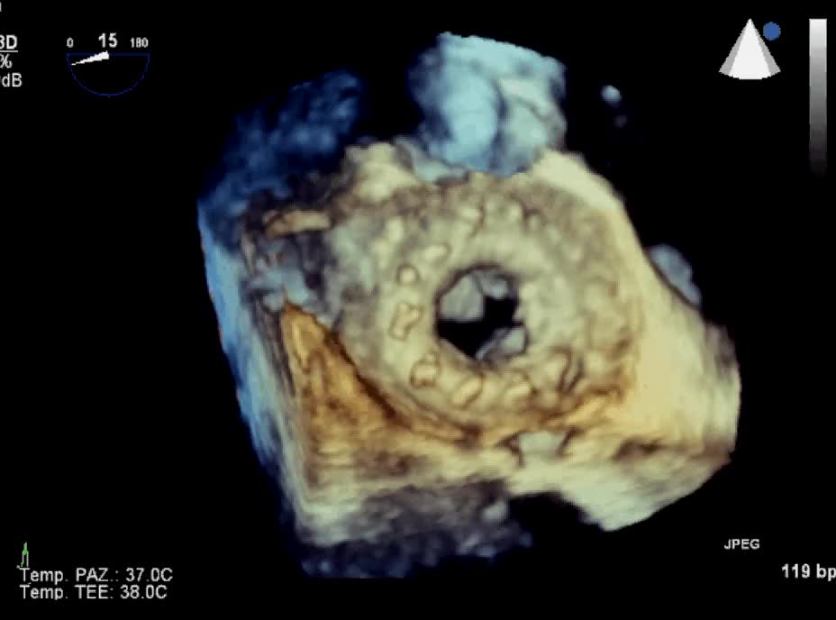 Vegetazioni su protesi mitralica biologica