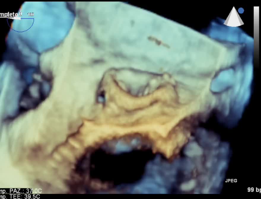 Distacco di protesi mitralica biologica