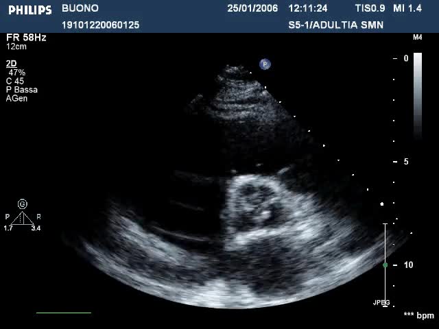 Cardiomiopatia aritmogena