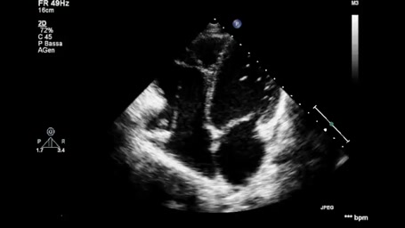 Cardiomiopatia aritmogena