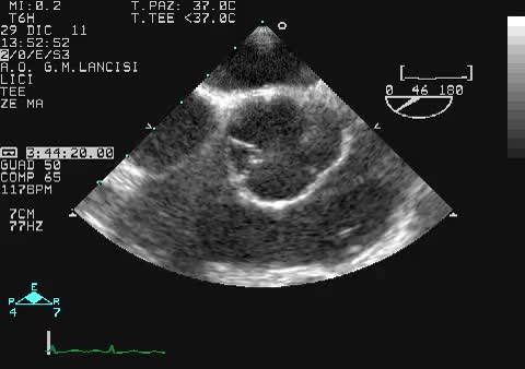 Valvola aortica quadricuspide
