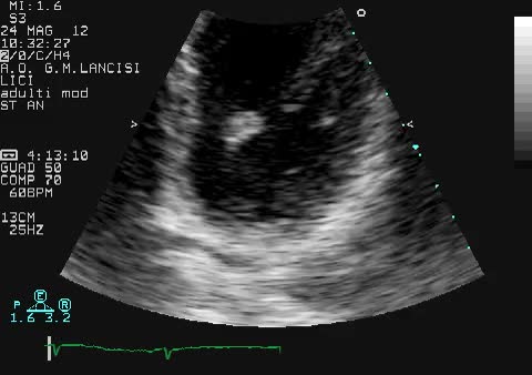 Fibroelastoma della valvola mitrale