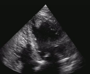 Trombo in apice del VS