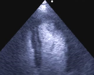 Regressione di trombosi dell’apice VS