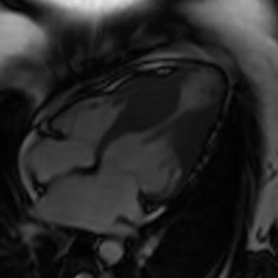 Cardiomiopatia ipertrofica