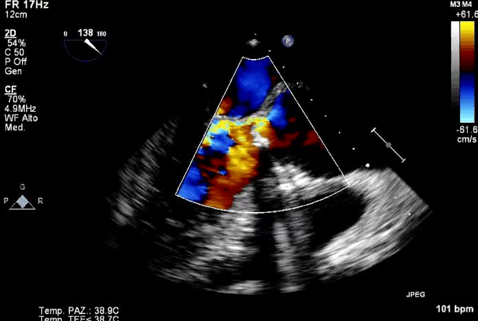 Ascesso perianulare e distacco di protesi aortica meccanica