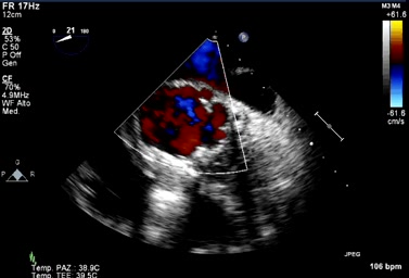 Ascesso perianulare e distacco di protesi aortica meccanica