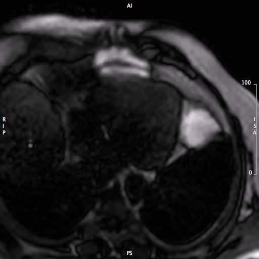 Trombo endoventricolare