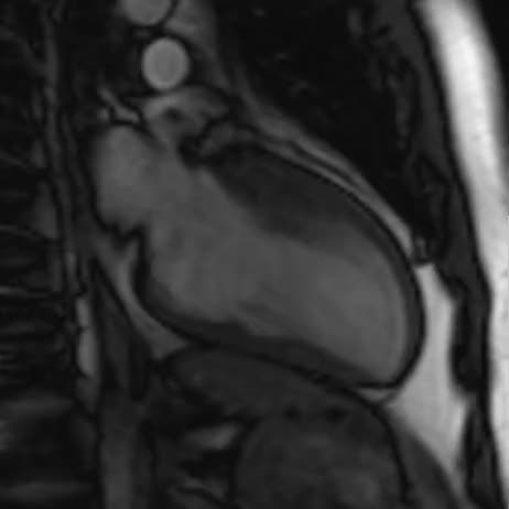 Cardiomiopatia ipertrofica