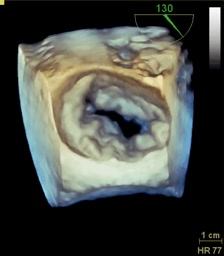Prolasso mitralico con rottura cordale