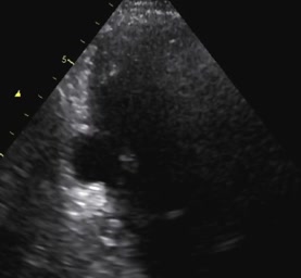 Aneurisma del ventricolo sinistro circoscritto