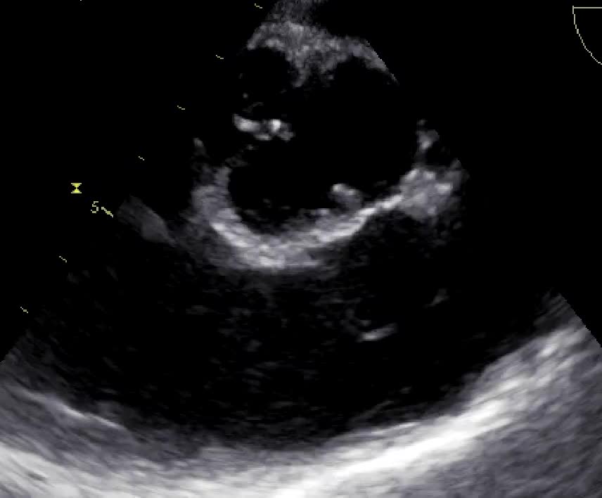 Valvola aortica e polmonare