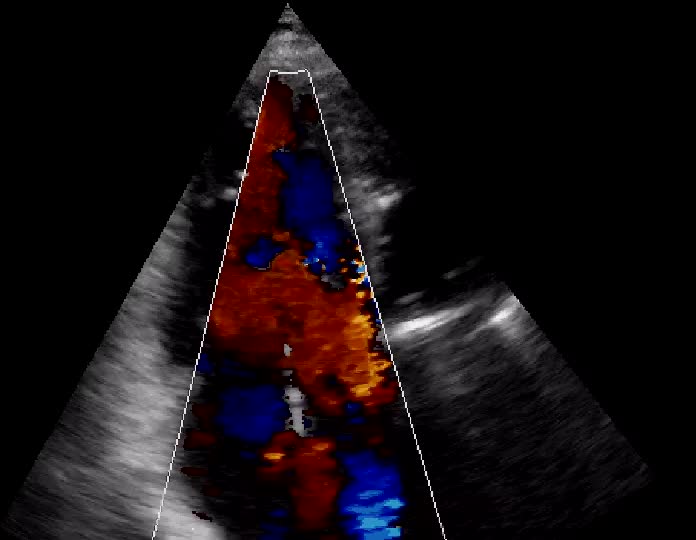 Insufficienza tricuspidale severa