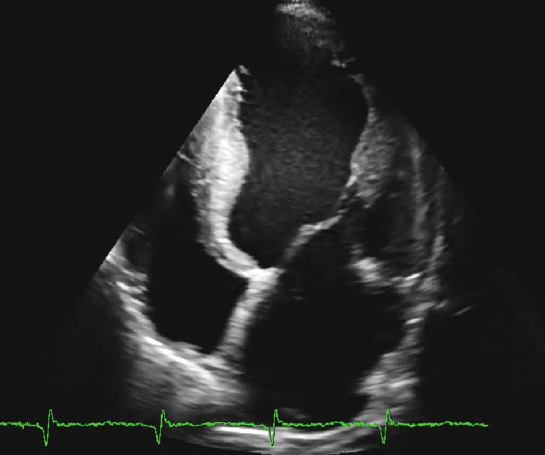 Glicogenosi cardiomiopatia restrittiva