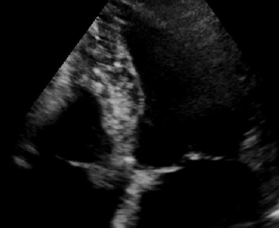 Massa adesa al lembo settale della tricuspide