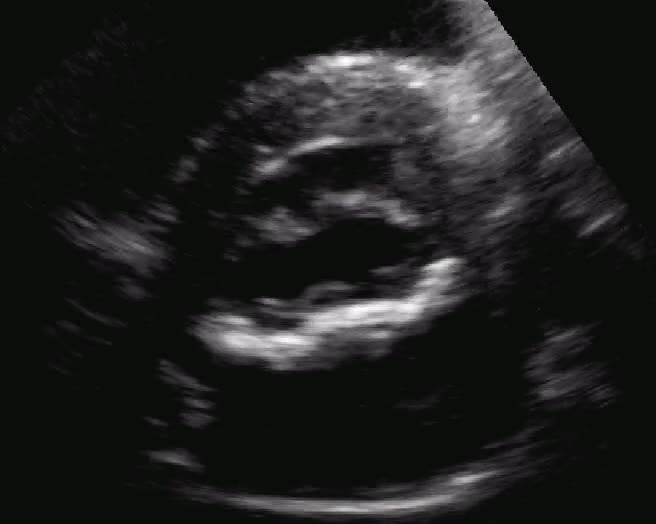 Grossolana calcificazione dell’anulus mitralico