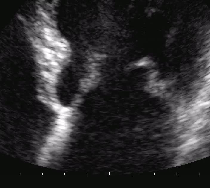 Prolasso mitralico con IM severa