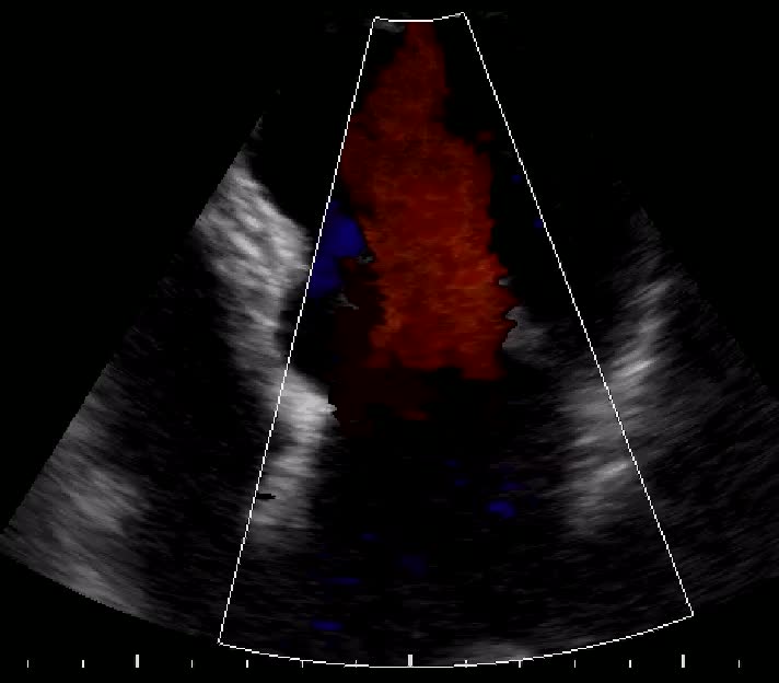Prolasso mitralico con IM severa