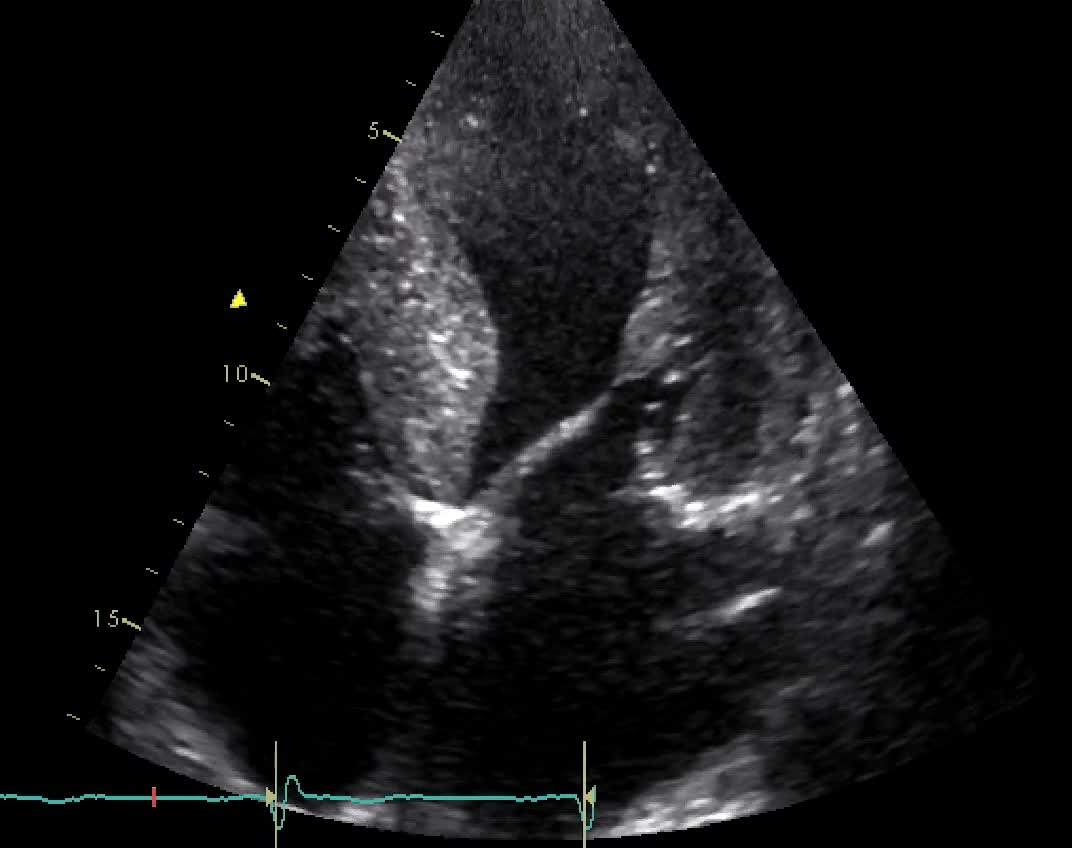 Ipertrofia concentrica del ventricolo sinsitro