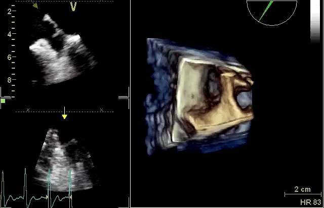 Auricola sinistra e vena polmonare superiore sinistra