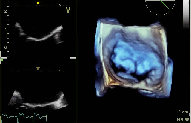 Insufficienza mitralica da rottura cordale