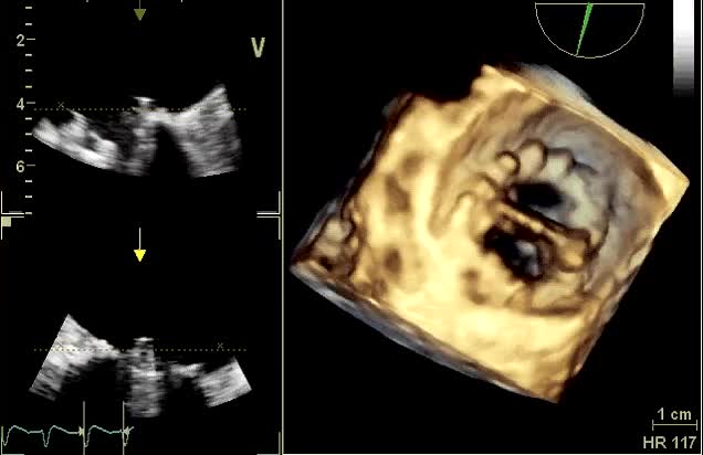 Protesi mitralica normofunzionante