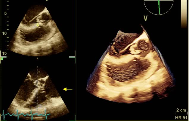 Endocardite della valvola aortica