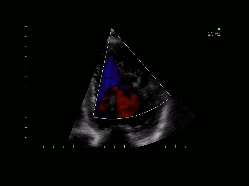 Non compattazione del VS