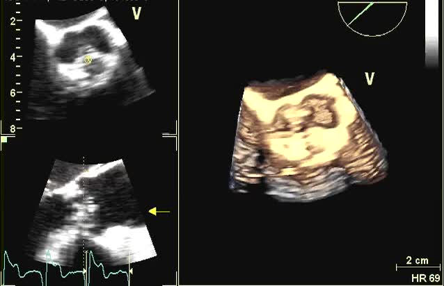 Stenosi aortica moderata