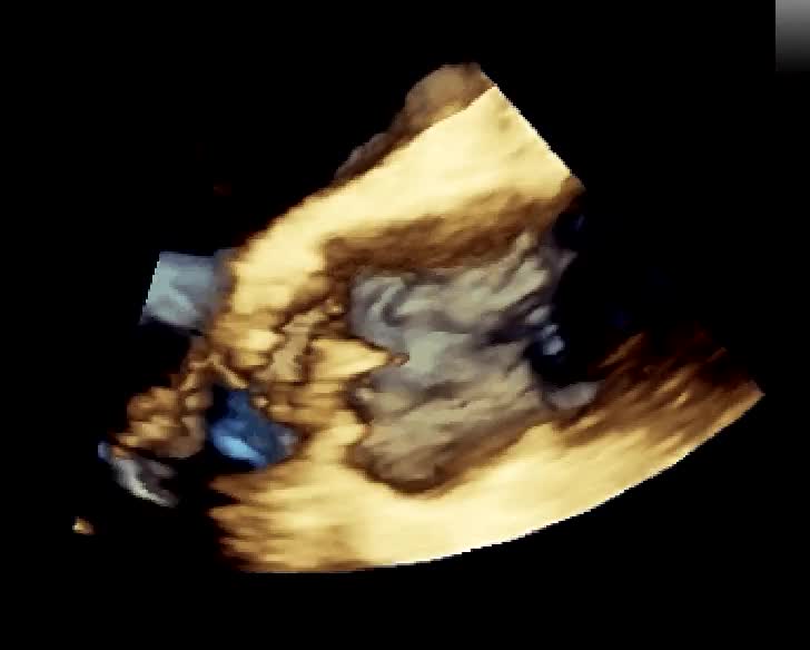 Insufficienza aortica severa da rottura di semilunare non coronarica