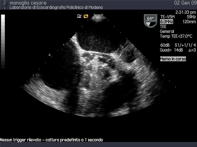 Ascesso periprotesico e distacco di protesi aortica biologica
