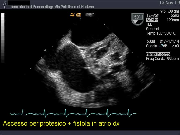 Ascesso periprotesico in protesi aortica biologica e fistola in atrio destro