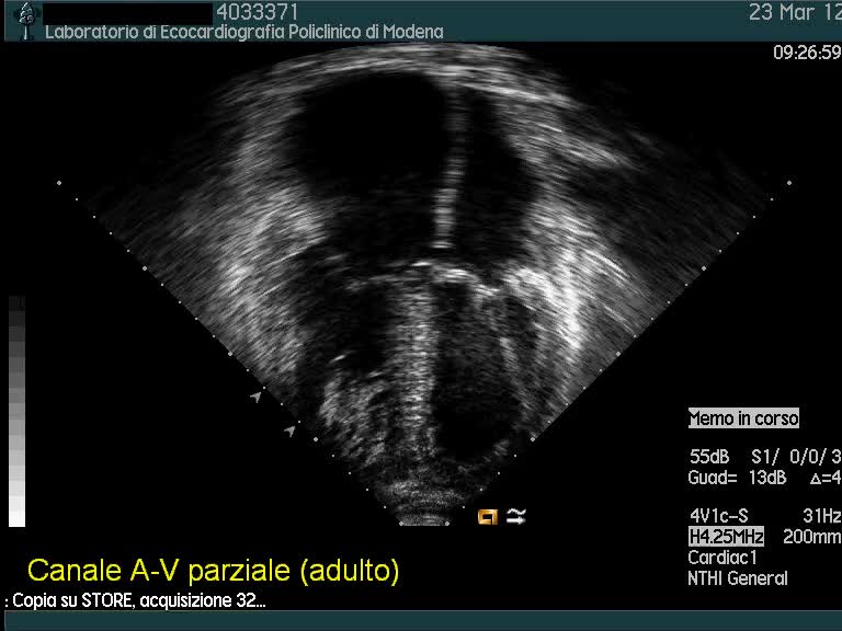 Dia ostium primum (canale av)